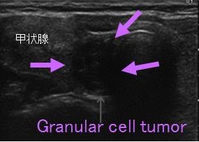 Granular cell tumor超音波検査(エコー)画像